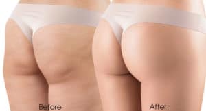 Gluteal Implants