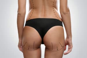 Butt Augmentation Los Angeles - Butt Implants - Gluteal Implant