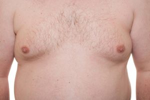 Gynecomastia Surgery Beverly Hills