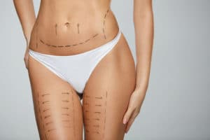 Liposuction Beverly Hills  Abdomen, Hips, Thighs - Procedure