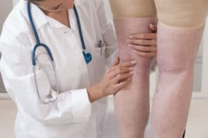 Varicose Veins Treatment Beverly Hills