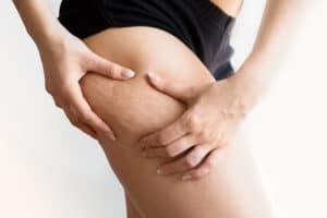 Cellulite Laser Treatment Near me