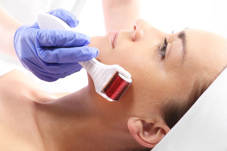 microneedling