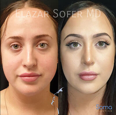 rhinoplasty procedure before and after